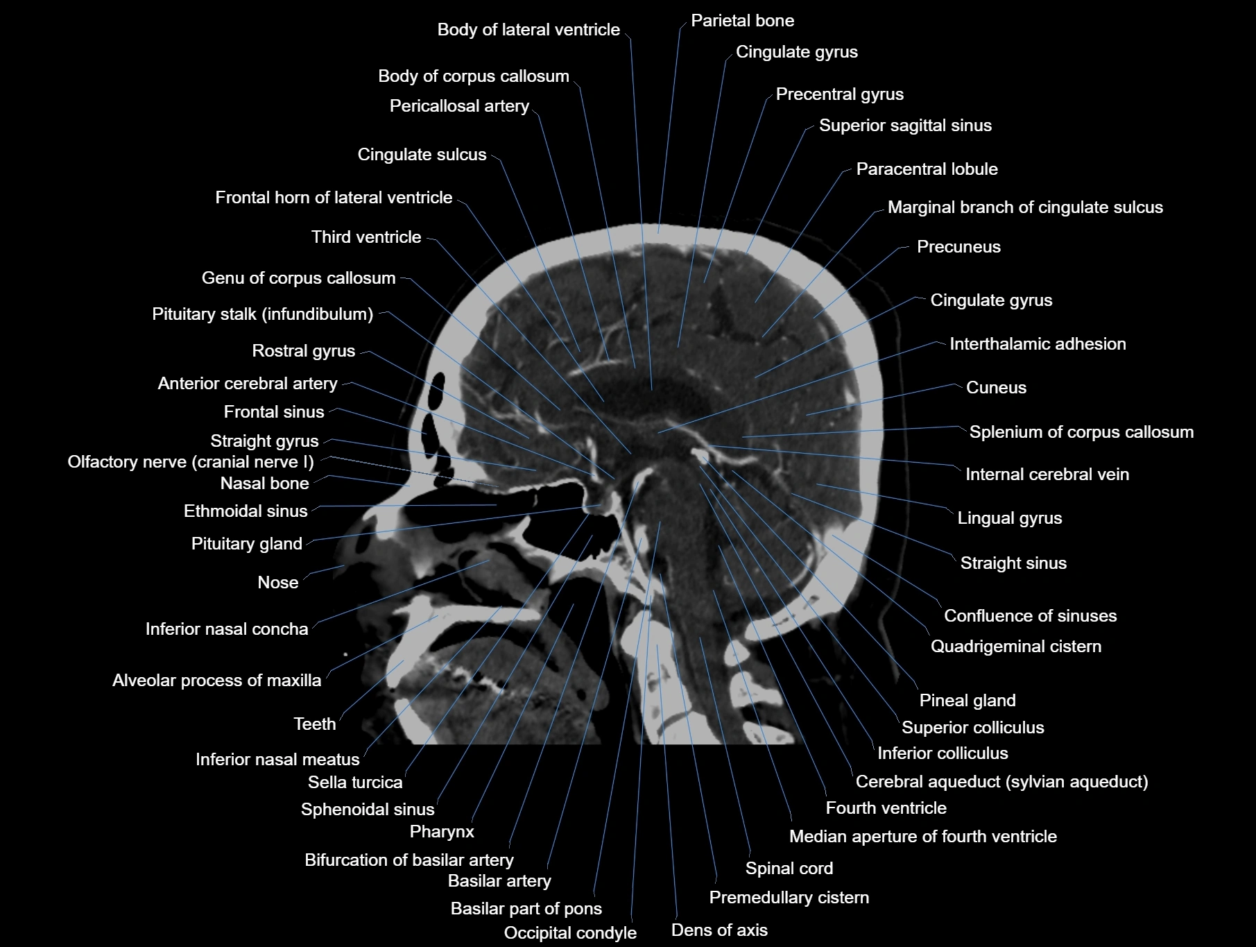 CT scan brain sagittal cross sectional anatomy image-img-00001-00040.webp